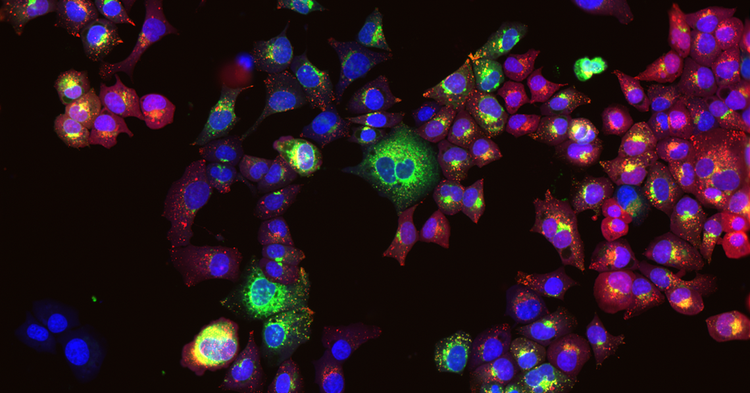 Trans Fats Inhibit Autophagy by Saturated Fatty Acids