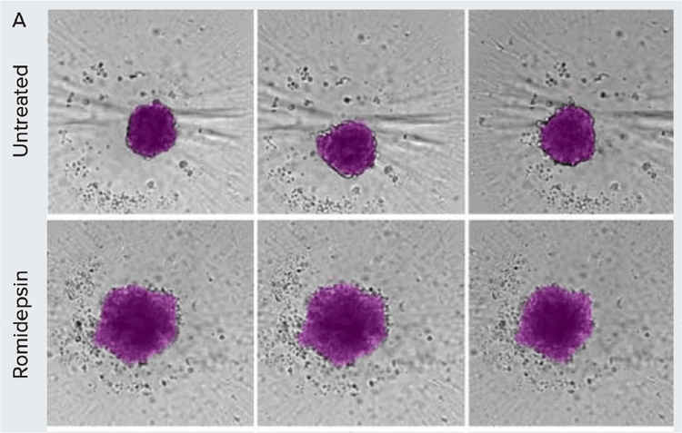 Morphometric analysis of compound treatment on patient-derived spheroids